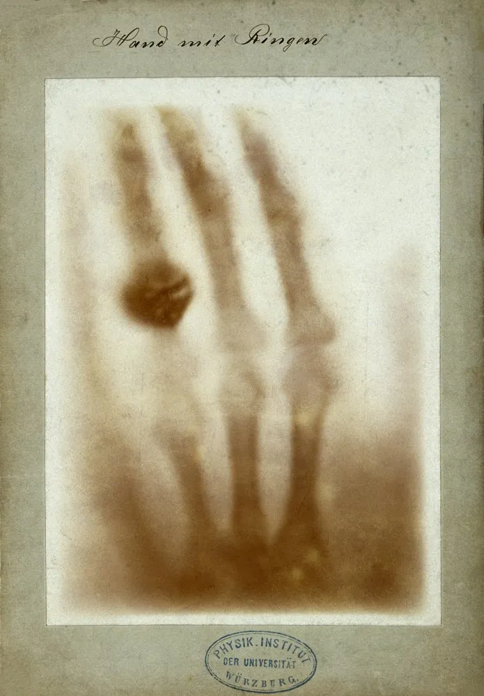 First medical radiograph in history: Anna Bertha Ludwig’s hand with rings, produced by Wilhelm Conrad Röntgen on December 22, 1895
